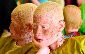 Court Sentences Man to Life for Killing Albino Brother and Selling His Body Parts as Good Luck Charms
