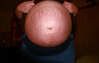 Dealing With Stretch Marks; Acknowledging the Body After Pregnancy