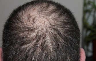 Male Pattern Baldness: Why Do Many Fathers Lose Hair?