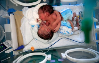3-Month-Old Conjoined Twins Sharing Liver Successfully Separated in Historic Surgery