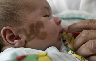 Mother Detained Overnight After Doctors Mistake Baby's Birthmarks for Bruises, Sparking Abuse Allegations