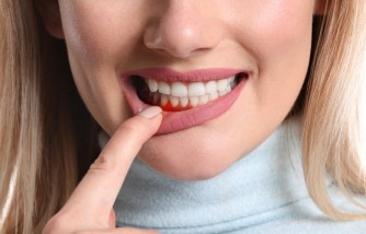 Periodontal Disease Stages and How to Reverse Them